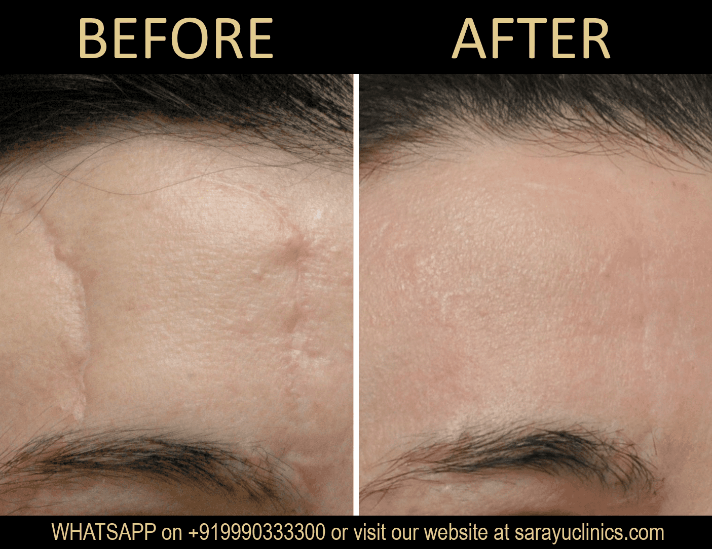 Face Scar Removal Treatment in Delhi SARAYU CLINICS Surgery Scar Removal in Delhi