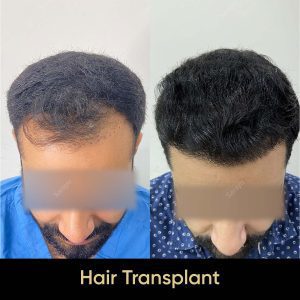 1 11 SARAYU CLINICS Hair Transplant in Delhi