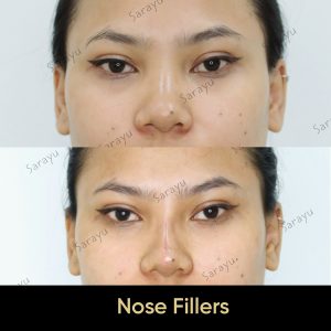 Nose plastic surgery in Delhi