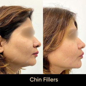 1 8 SARAYU CLINICS Chin Fillers in Delhi