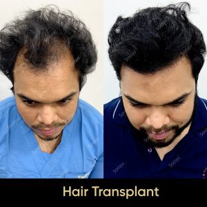 10 SARAYU CLINICS Hair Transplant in Delhi