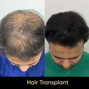 12 1 SARAYU CLINICS Hair Transplant in Delhi