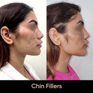 2 14 SARAYU CLINICS Chin Fillers in Delhi