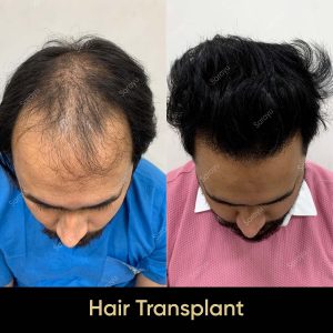 2 17 SARAYU CLINICS Hair Transplant in Delhi