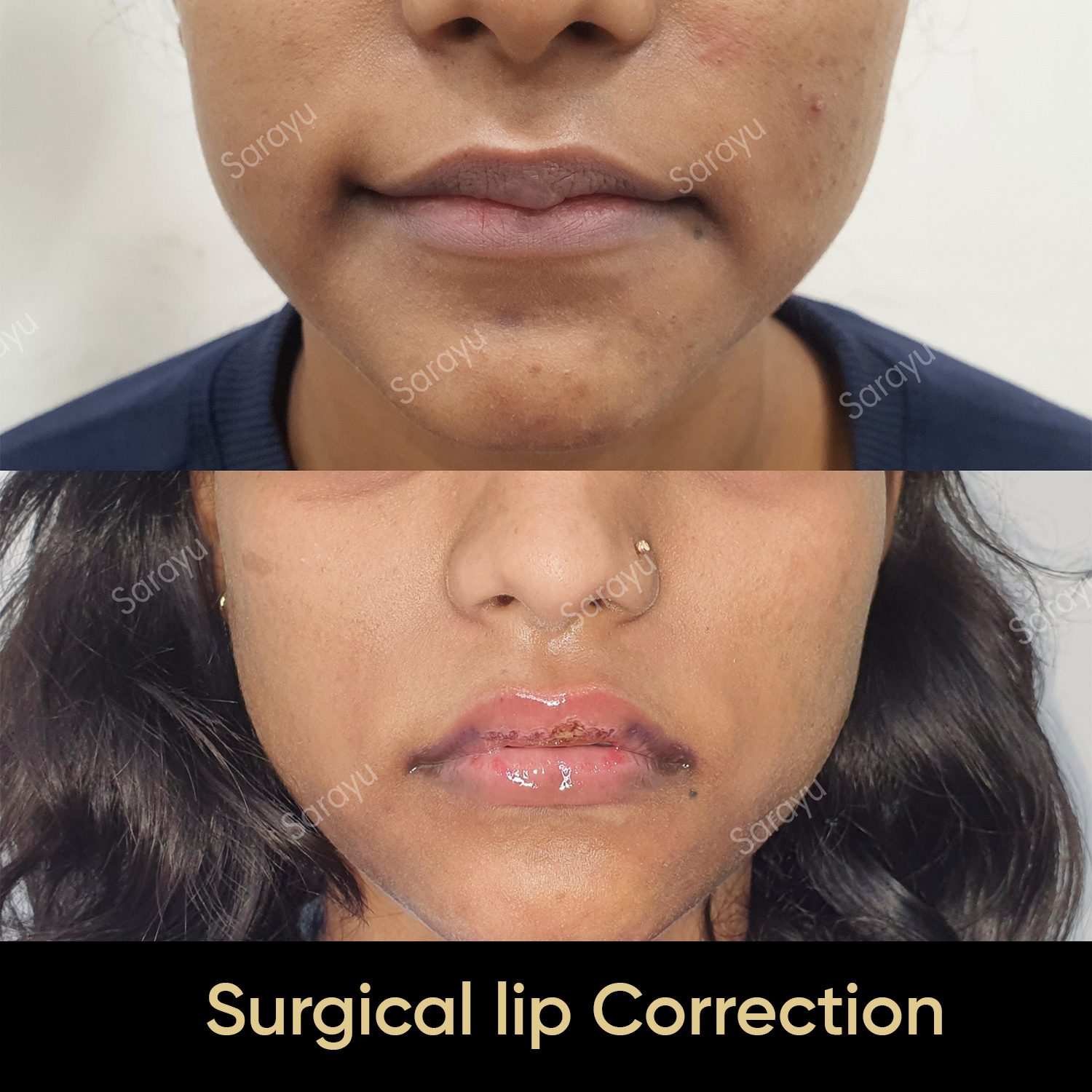 Surgical Lip Correction