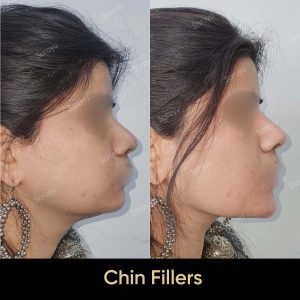 3 5 SARAYU CLINICS Chin Fillers in Delhi