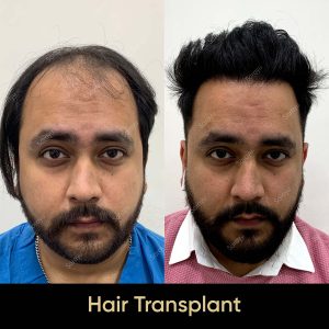 3 7 SARAYU CLINICS Hair Transplant in Delhi