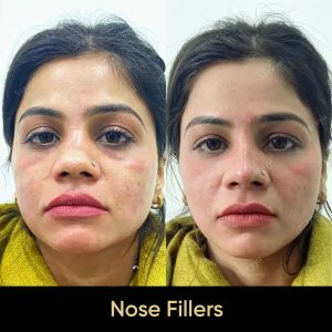 Nose plastic surgery