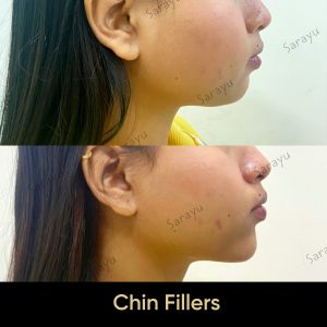 4 10 SARAYU CLINICS Chin Fillers in Delhi