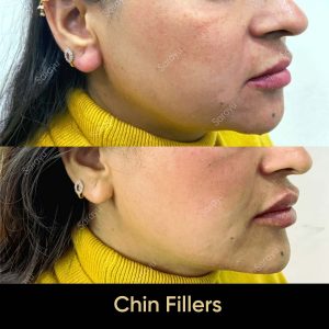 5 5 SARAYU CLINICS Chin Fillers in Delhi