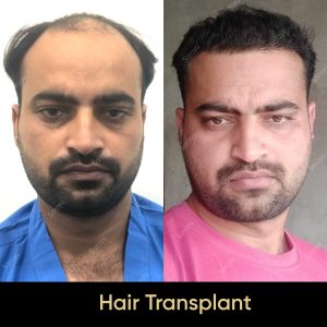 5 6 SARAYU CLINICS Hair Transplant in Delhi