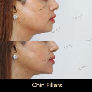 6 4 SARAYU CLINICS Chin Fillers in Delhi