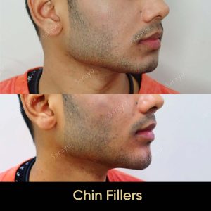 7 3 SARAYU CLINICS Chin Fillers in Delhi