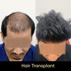 7 4 SARAYU CLINICS Hair Transplant in Delhi