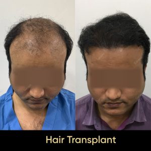 8 2 SARAYU CLINICS Hair Transplant in Delhi