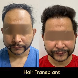 9 1 SARAYU CLINICS Hair Transplant in Delhi