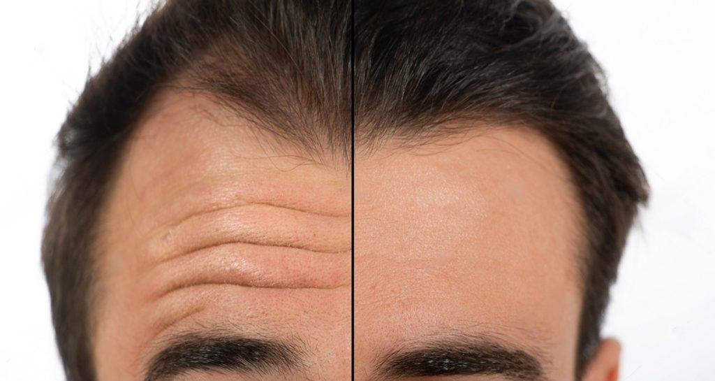 Exploring anti-aging and Forehead Wrinkle Removal in Delhi