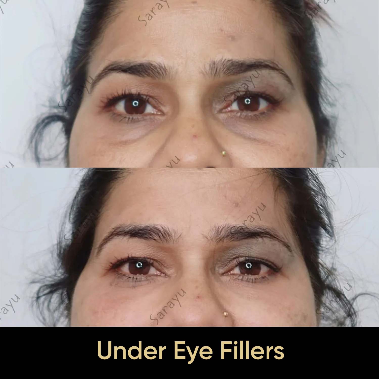 Close-up of a person's face with improved under-eye area smoothness and reduced appearance of dark circles/puffiness.