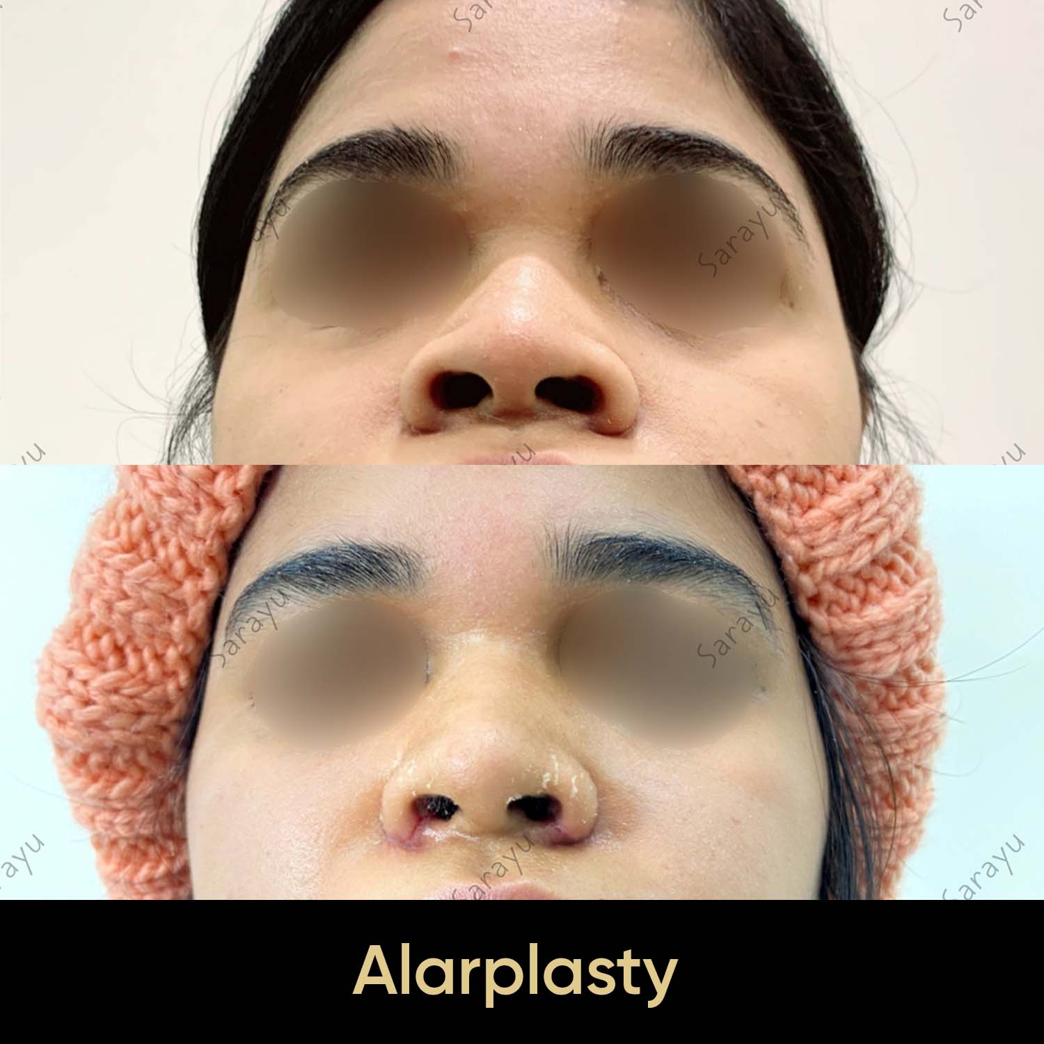 Close-up of a face with a slightly refined nose profile after Alarplasty Surgery in Delhi