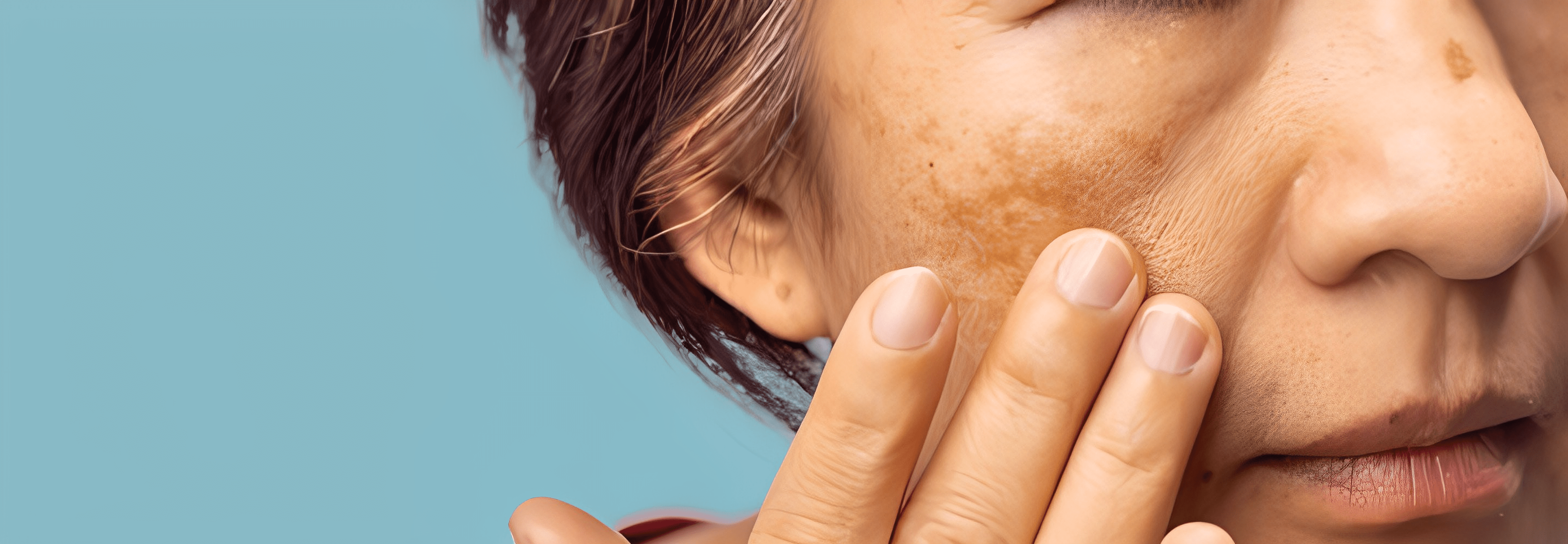 Woman with melasma receiving treatment from a dermatologist in Delhi.