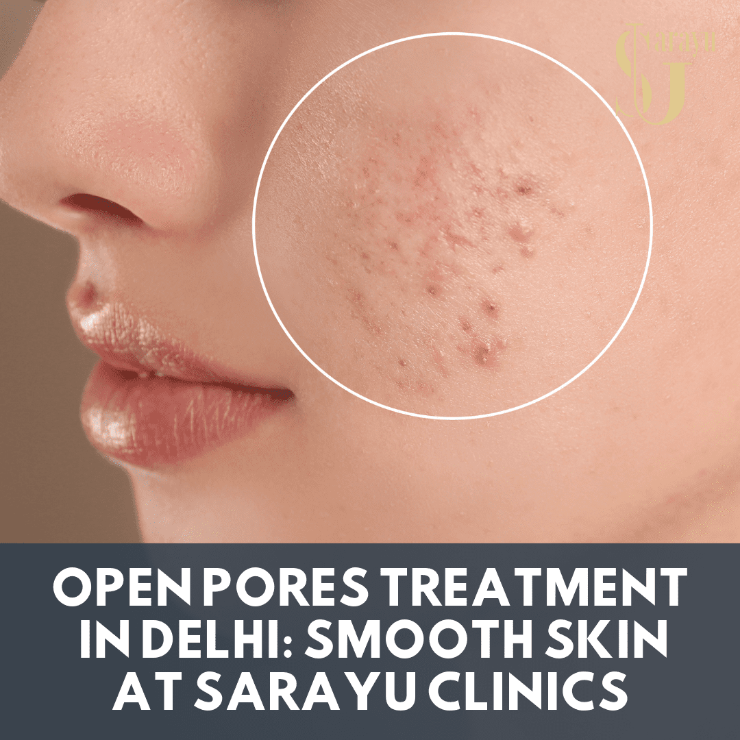 Open Pores Treatment In Delhi Smooth Skin At Sarayu Clinics 