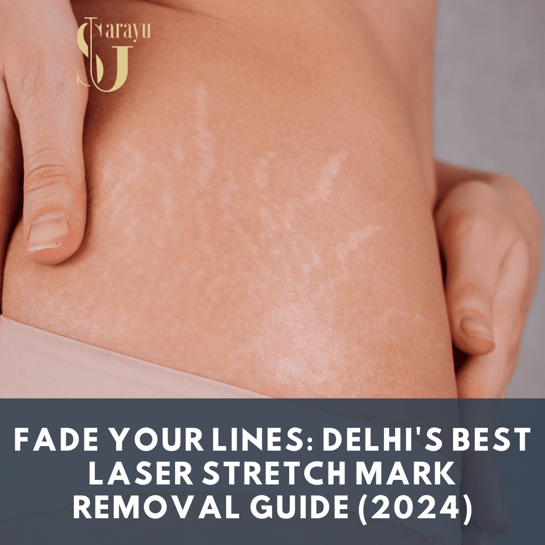 Photo of a dermatologist operating a laser machine during a stretch mark removal procedure, demonstrating the advanced technology and expertise involved.Best Stretch Marks Removal in Delhi