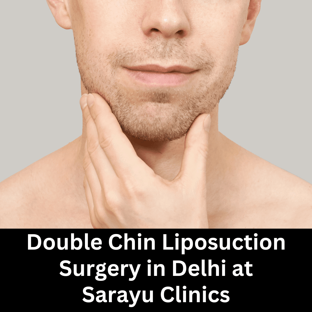 Double Chin Liposuction Surgery in Delhi: Woman undergoing chin liposuction procedure for fat removal