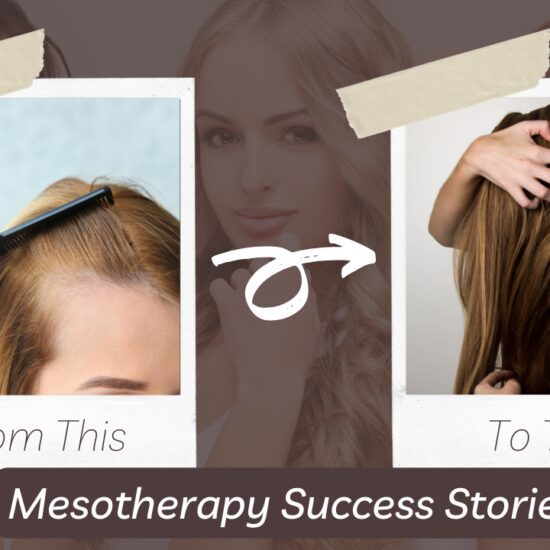 Mesotherapy treatment for hair loss in Delhi, India