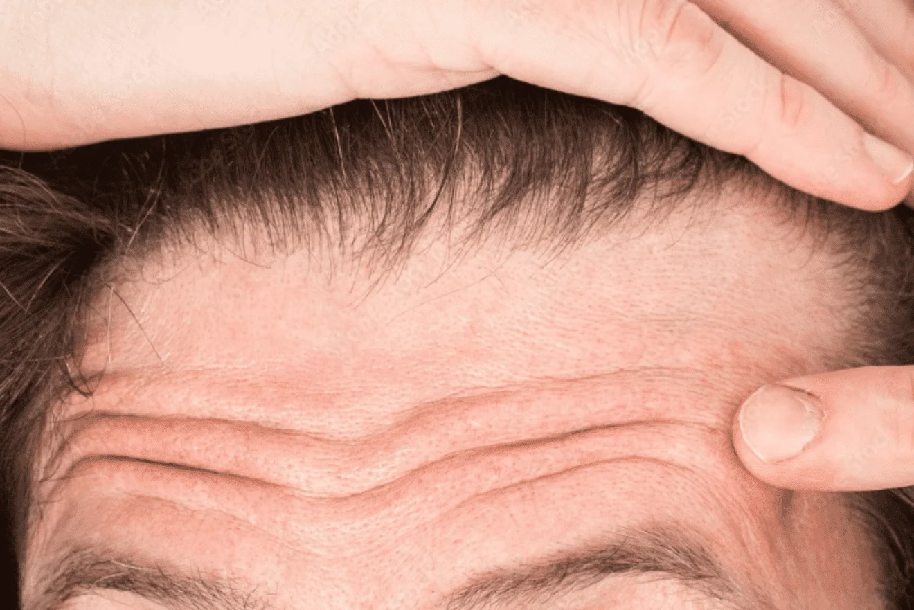 Forehead lines 1320x881 1 Mesotherapy for Hair Loss in Delhi