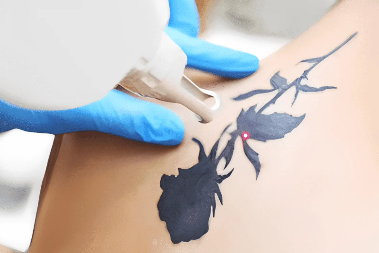 Tattoo Removal 1320x881 1 Mesotherapy for Hair Loss in Delhi