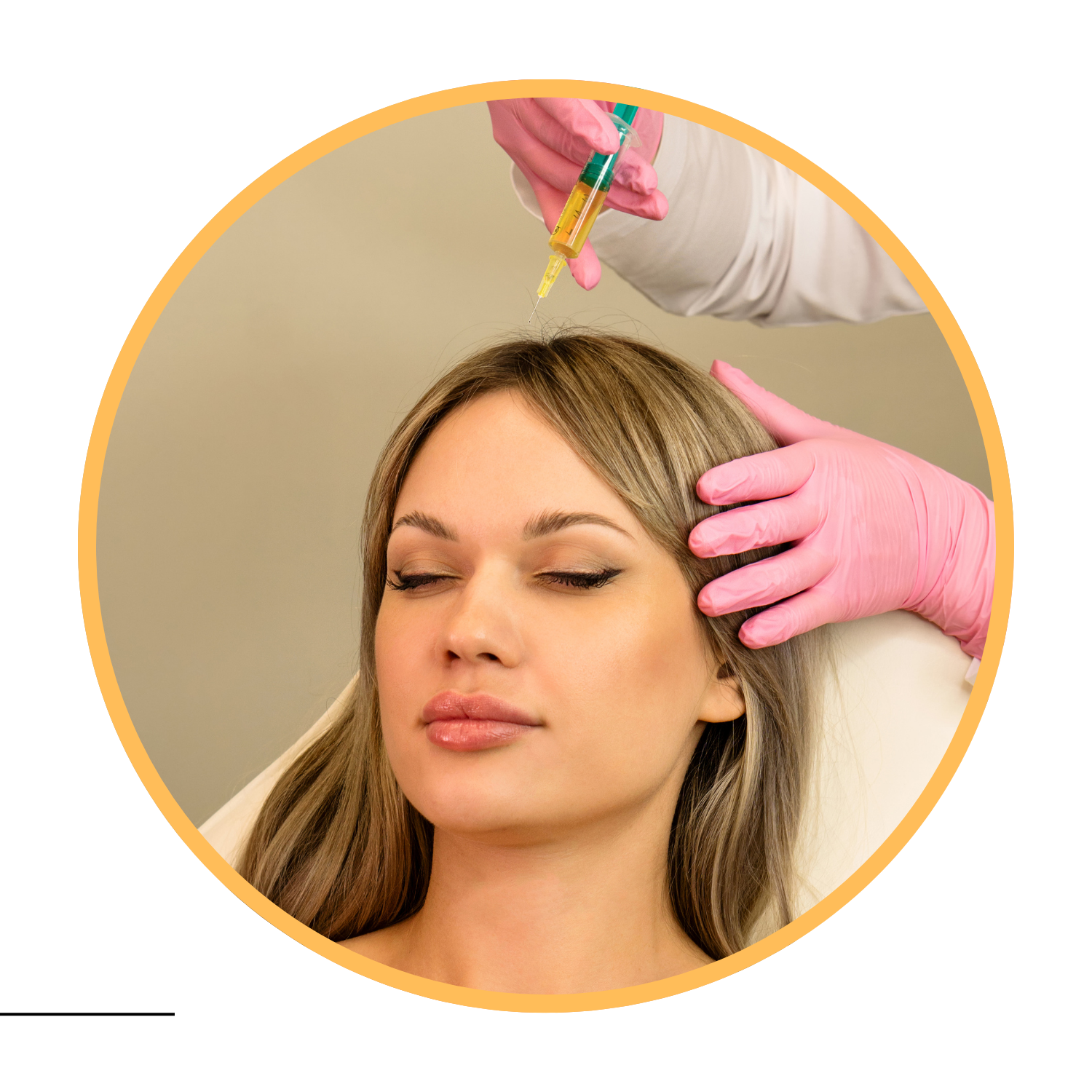 vg 3 Mesotherapy for Hair Loss in Delhi