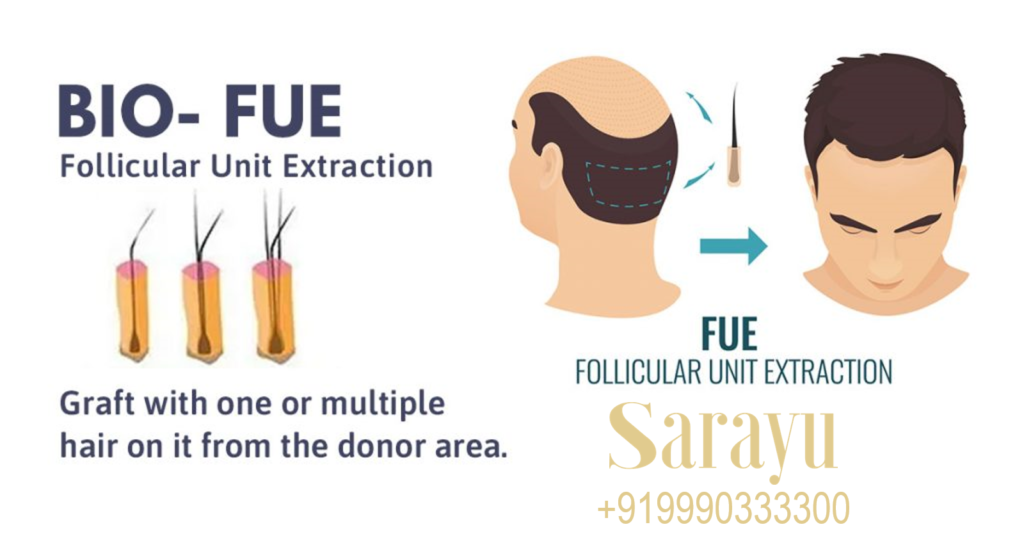 BIO FUE Hair Transplant in Delhi at Sarayu Clinics for natural hair growth and restoration.