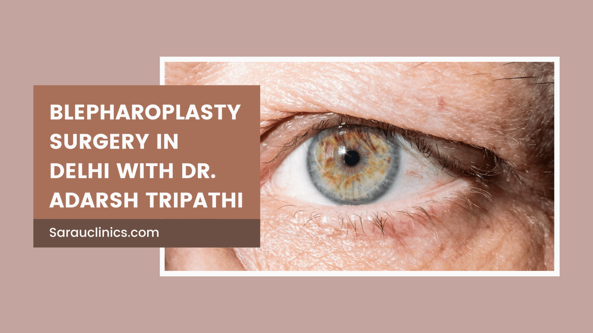 You are currently viewing Blepharoplasty Surgery in Delhi with Dr. Adarsh Tripathi