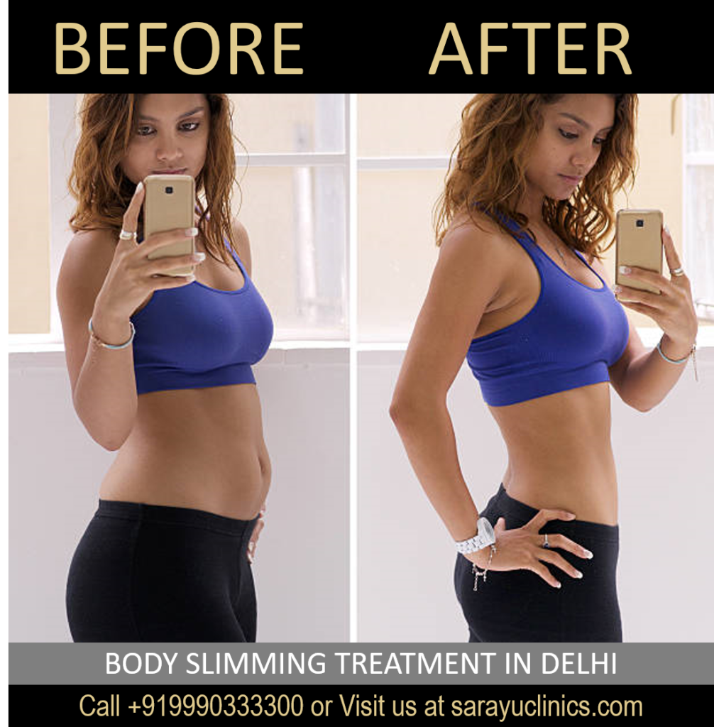 Body Slimming Treatment in Delhi | Advanced Slimming Solutions at Sarayu Clinics