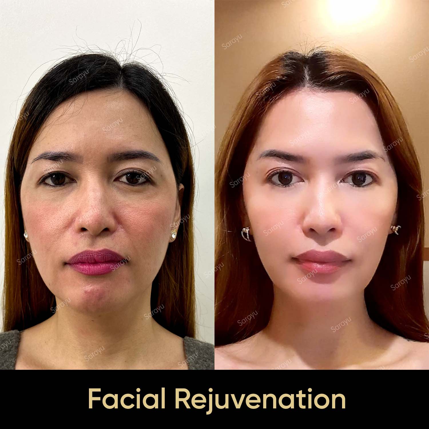 Facial-Rejuvenation