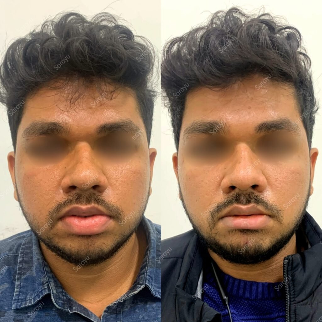 Patient undergoing lip reduction treatment in Delhi at Sarayu Clinics, performed by Dr. Adarsh Tripathi for a more balanced and proportionate lip shape.