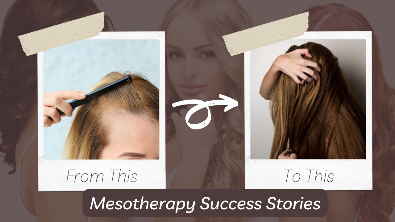 You are currently viewing Mesotherapy for Hair Loss: Success Stories and Before-and-After Results