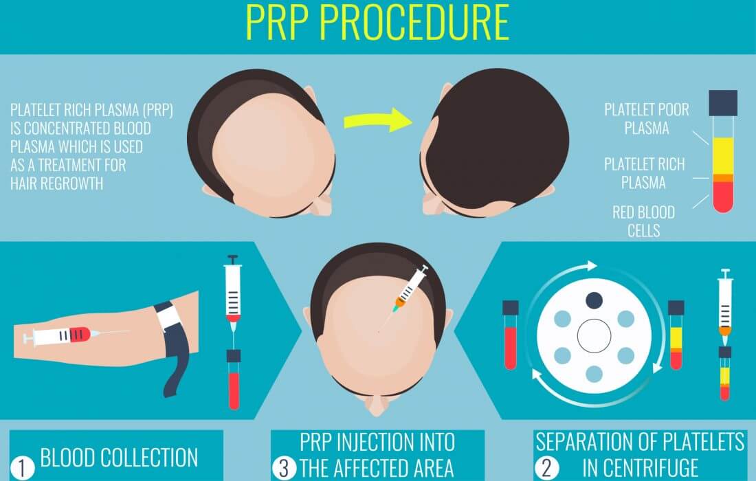 Best PRP Hair Treatment In Delhi | Best PRP Hair Treatment In Delhi Cost