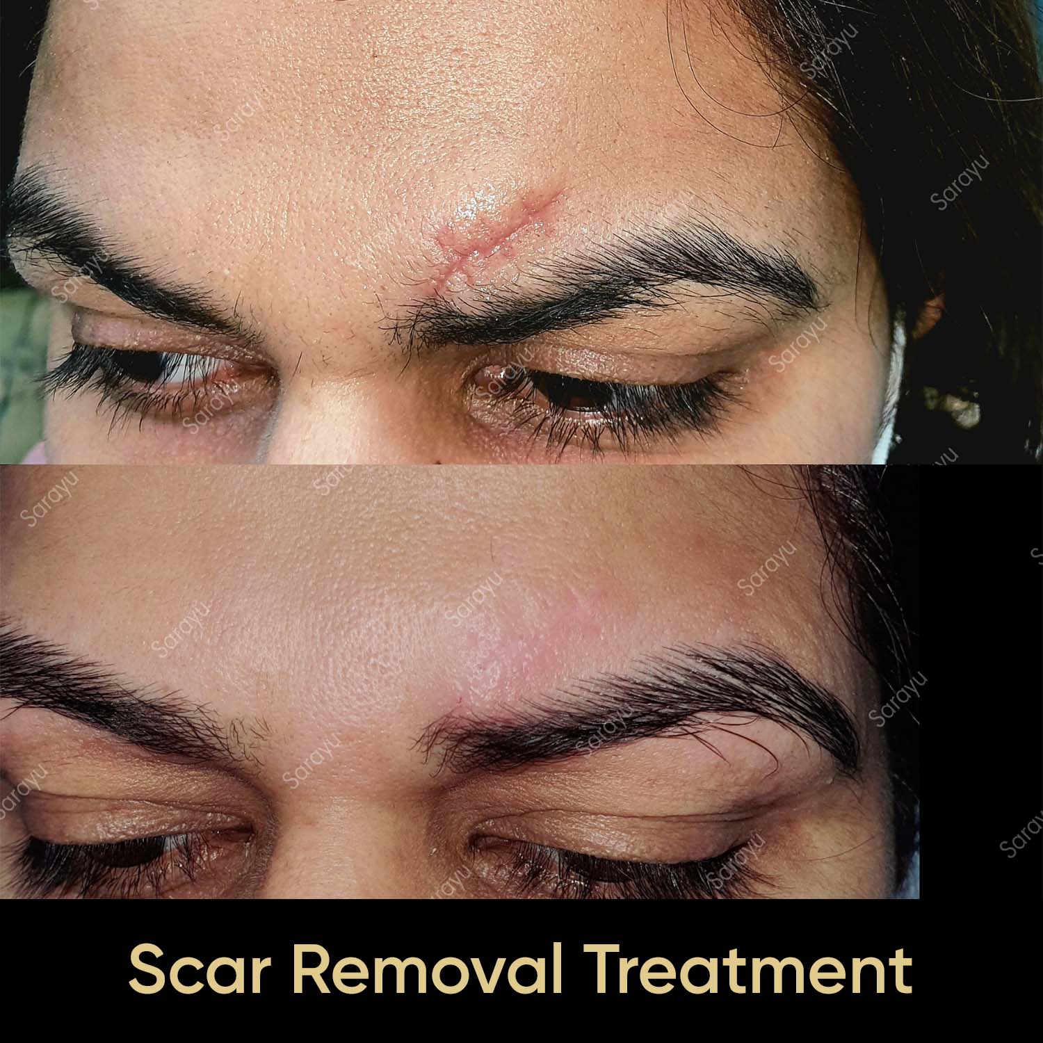 Scar-Removal-Treatment