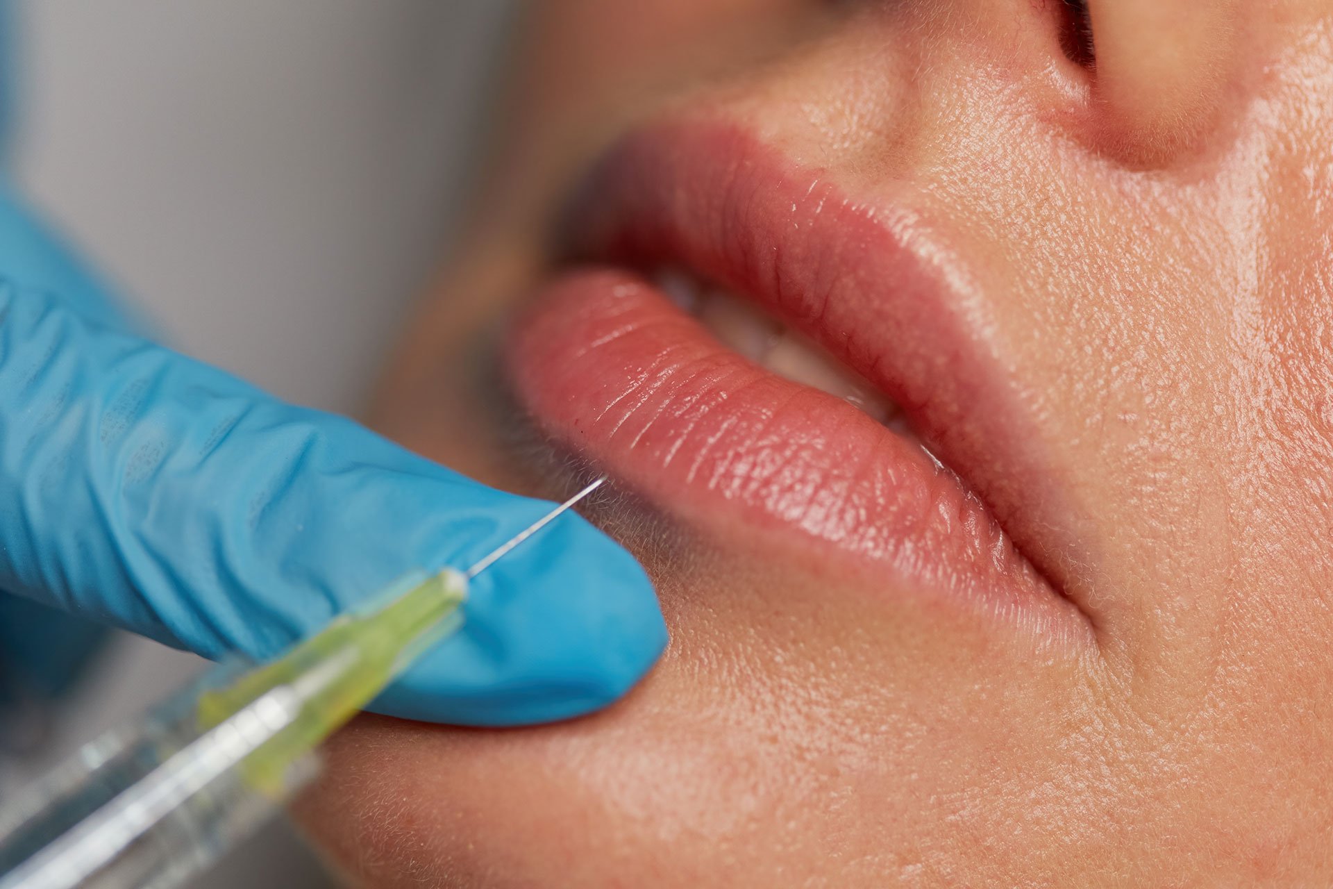 Patient receiving lip fillers in Delhi at Sarayu Clinics, administered by Dr. Adarsh Tripathi for fuller, more defined lips. Lip fillers in delhi price Top 10 lip fillers in delhi Best lip fillers in delhi Cheapest lip fillers in delhi Permanent lip fillers cost Permanent lip filler cost in India Lip fillers cost India