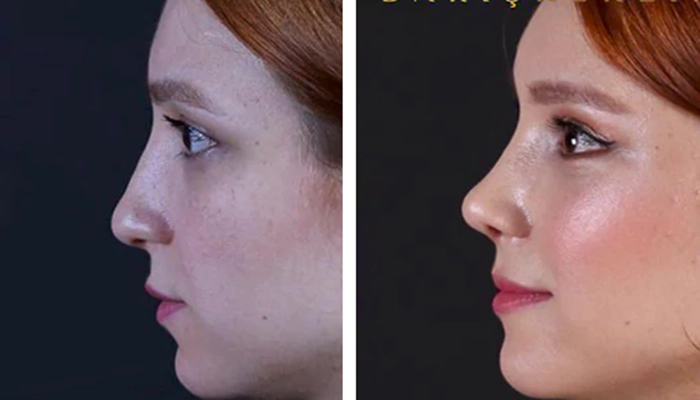 Patient receiving non-surgical rhinoplasty in Delhi at Sarayu Clinics, performed by Dr. Adarsh Tripathi for a refined, natural nose shape.