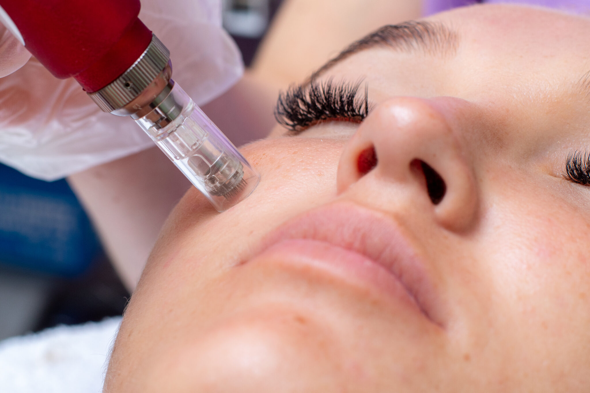 Patient receiving Skin Microneedling Treatment in Delhi at Sarayu Clinics, showcasing the microneedling device in action.