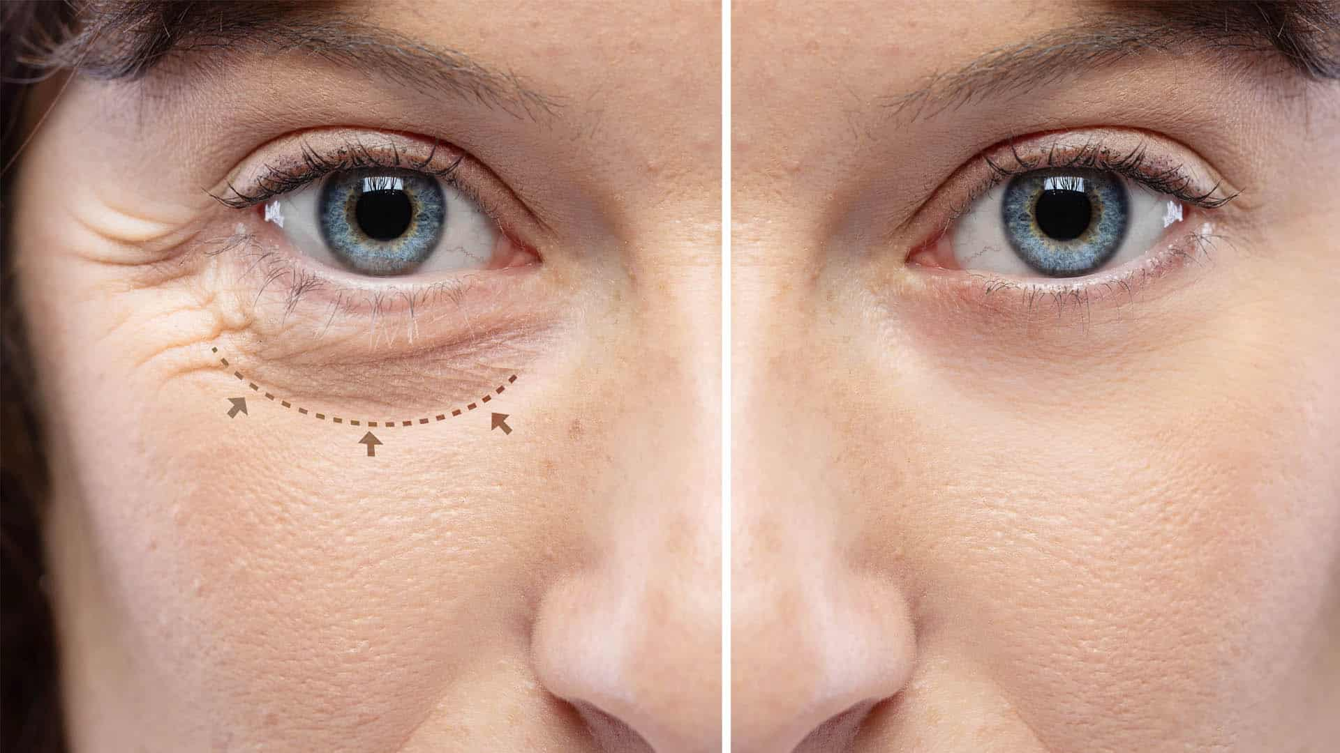 Best Blepharoplasty in Delhi India | #1 Upper Eyelid Surgery Cost In Delhi