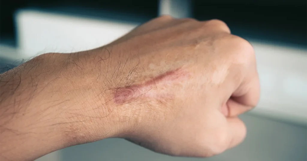 Burn-Mark-Removal-Treatment-in-Delhi
