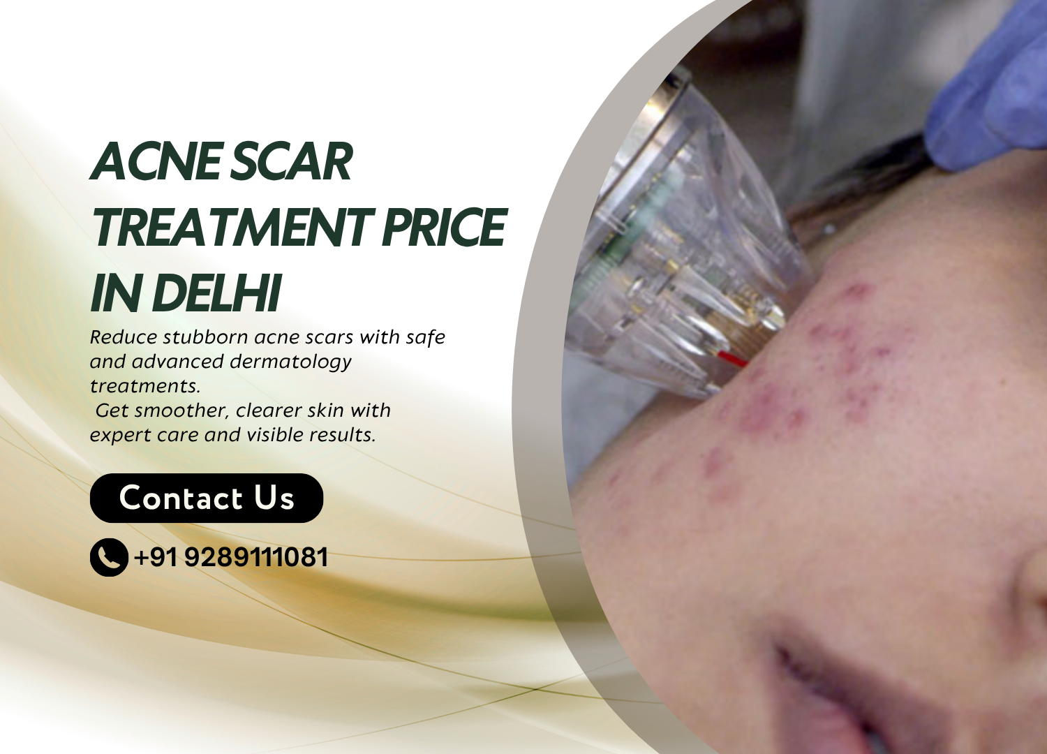 heal liver with glutathione Acne Scar Treatment Cost Delhi – Affordable & Effective Solutions