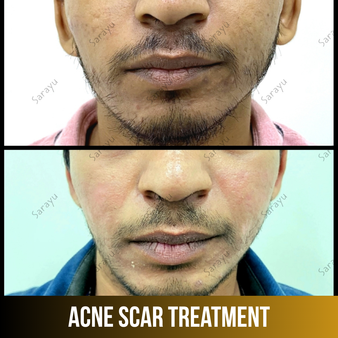 Explore acne scar treatment at Sarayu Clinics in Delhi, designed to reduce acne scars, improve skin texture, and restore a smoother, healthier-looking complexion with advanced dermatological care.