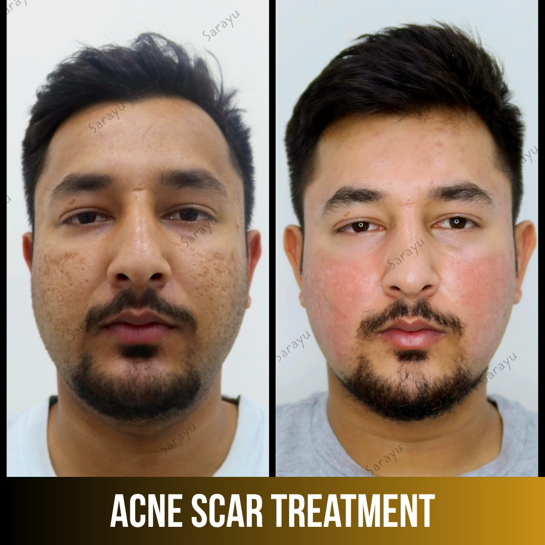 Patient receiving acne scar treatment at Sarayu Clinics in Delhi to reduce acne scars, improve skin texture, and achieve smoother, clearer skin.