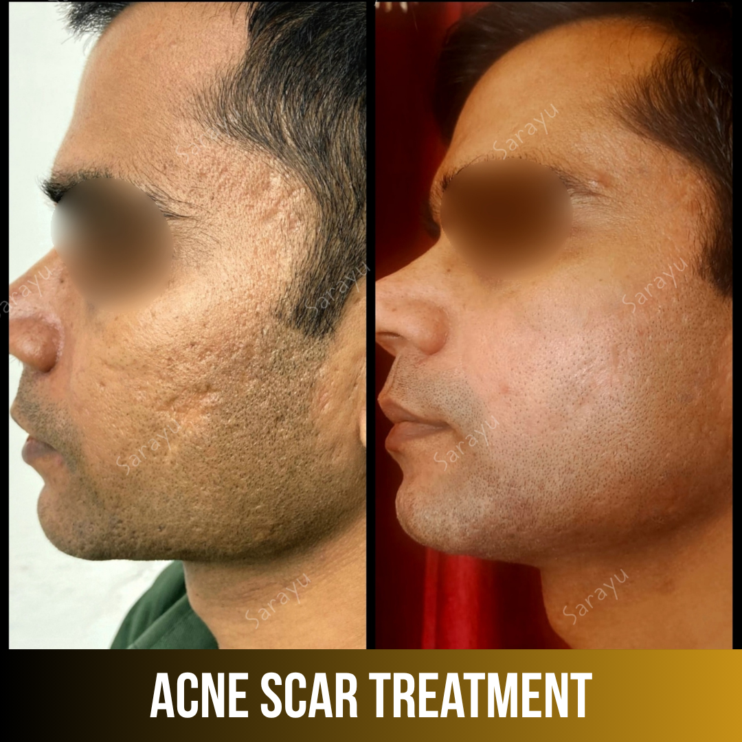 Patient receiving acne scar treatment at Sarayu Clinics in Delhi to reduce acne scars, improve skin texture, and achieve smoother, clearer skin.