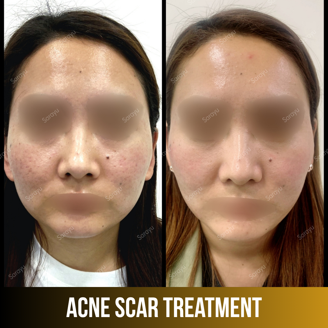 Patient receiving acne scar treatment at Sarayu Clinics in Delhi to reduce acne scars, improve skin texture, and achieve smoother, clearer skin.