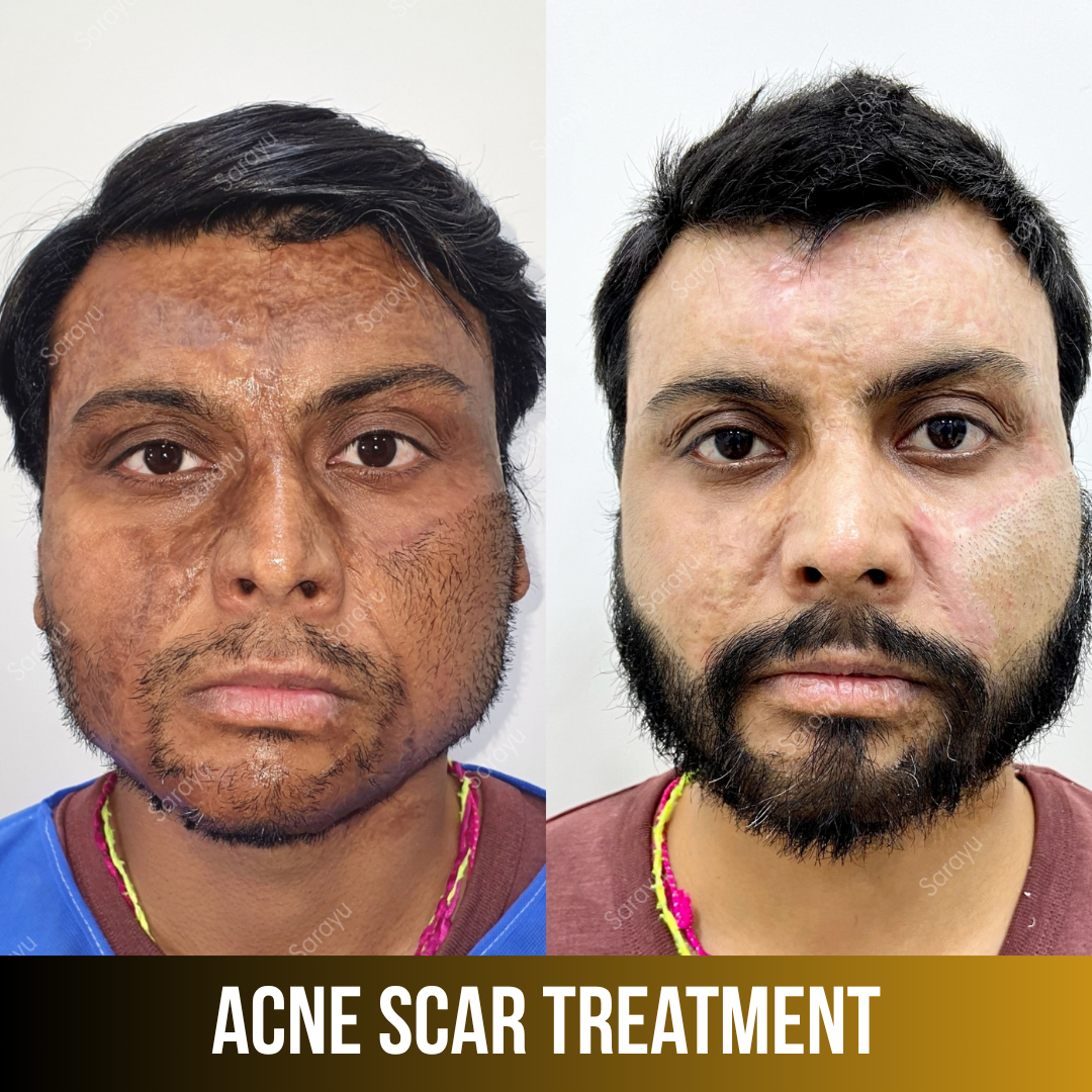 Patient receiving acne scar treatment at Sarayu Clinics in Delhi to reduce acne scars, improve skin texture, and achieve smoother, clearer skin.